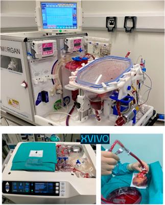 Heart Transplantation and Donation After Circulatory Death in Children. A Review of the Technological, Logistical and Ethical Framework